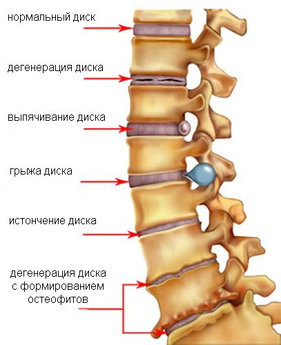 Мышечные дисбалансы и неравномерная нагрузка